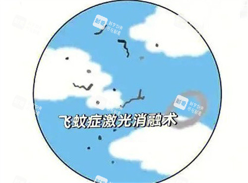 飞蚊症激光消融术 飞蚊症激光消融术