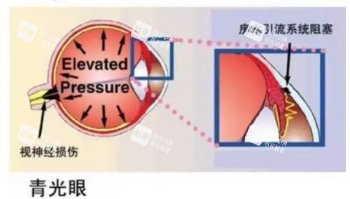 青光眼是什么原因导致的 青光眼是什么原因导致的