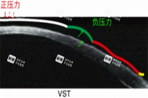 VST角膜塑形镜力的示意图