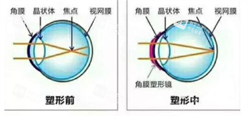 角膜塑形镜塑形时