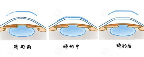 角膜塑形镜矫正原理