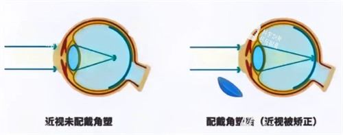 角膜塑形镜前后