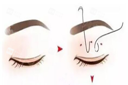 埋线双眼皮卡通示意图 埋线双眼皮卡通示意图