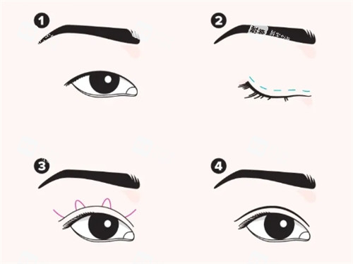 埋线双眼皮手术过程图 埋线双眼皮手术过程图