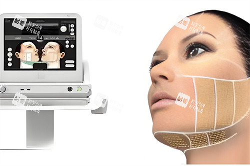 ulthera 超声提拉