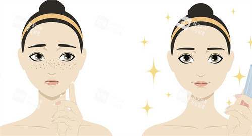 祛痣前后对比