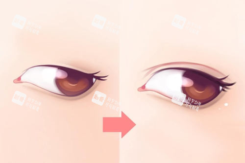 双眼皮整形图 双眼皮整形图