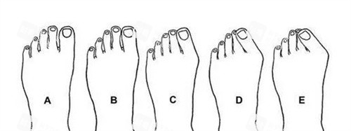 拇外翻程度 拇外翻程度