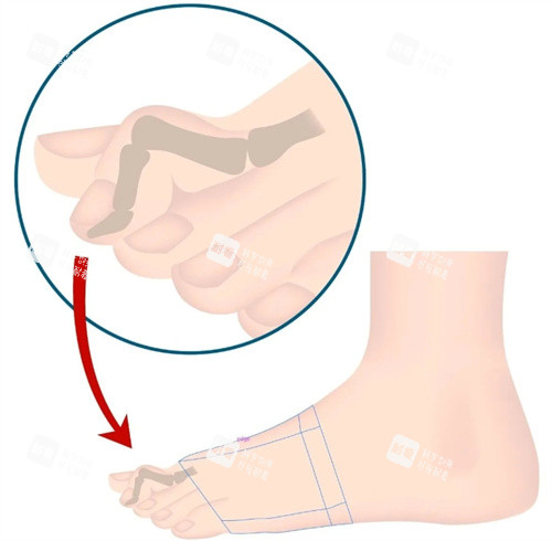 二脚趾过长放大图 二脚趾过长放大图