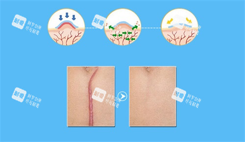 疤痕示意图 疤痕示意图