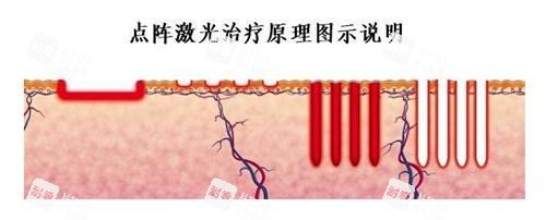 点阵激光的原理