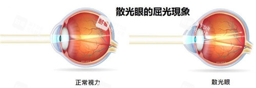 散光 散光