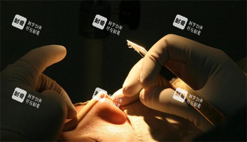 隆鼻整形细节图 隆鼻整形细节图