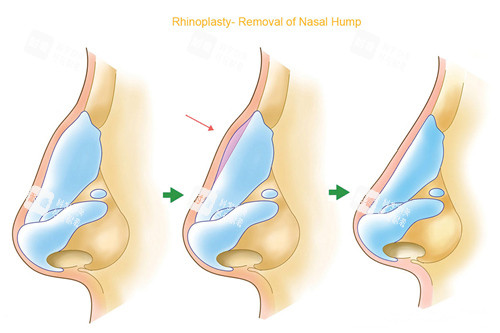 鼻部整形过程图 鼻部整形过程图