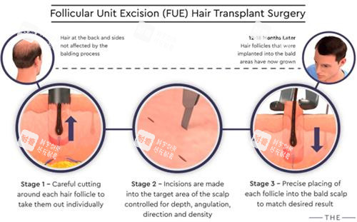 毛囊移植过程图解