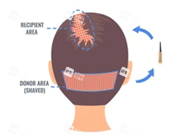 后枕毛囊移植过程图解 后枕毛囊移植过程图解