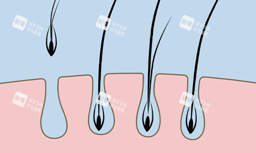 单毛囊植发展示 单毛囊植发展示