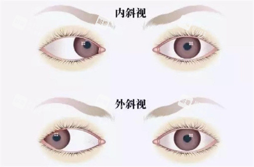 斜视分类图 斜视分类图