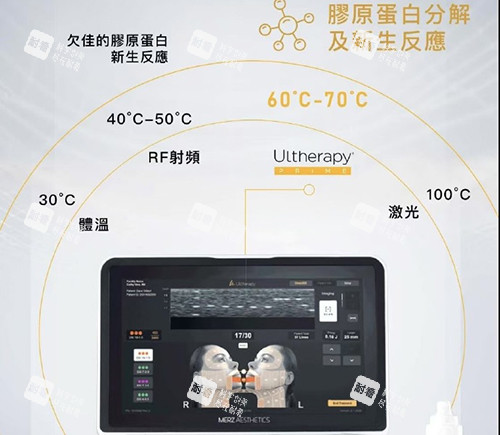 美版超声刀二代