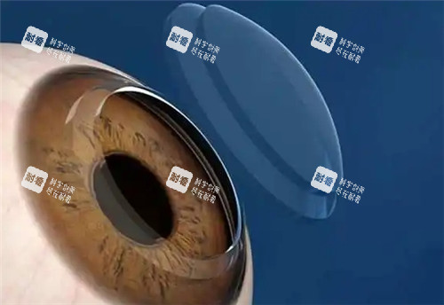 角膜塑形镜佩戴图