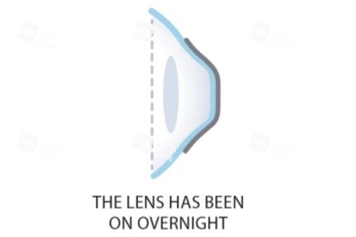 佩戴角膜塑形镜一整夜