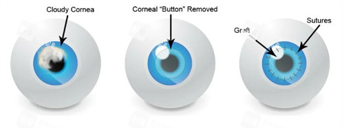 角膜移植图示 角膜移植图示