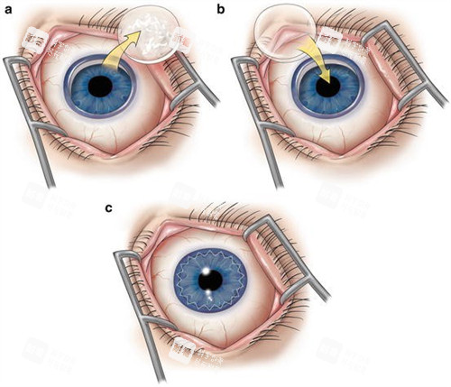 角膜移植过程展示 角膜移植过程展示