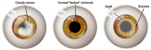 角膜移植动画图 角膜移植动画图