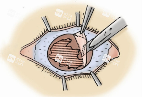 角膜移植 角膜移植