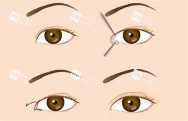 开眼角整形手术 开眼角整形手术