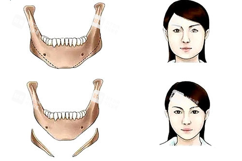 下颌角整形卡通对比图