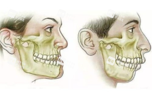 下颌角整形模型图