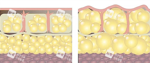 自体脂肪填充前后皮肤层动画图