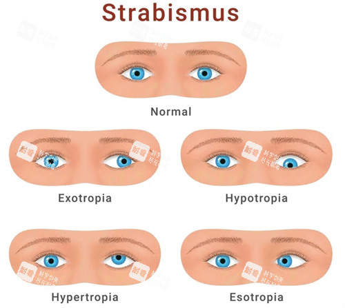 斜视手术不同症状 斜视手术不同症状