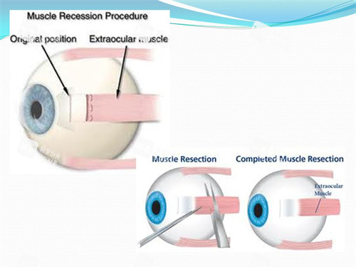 斜视手术原理图示 斜视手术原理图示