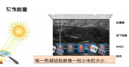超声王单点释能 超声王单点释能