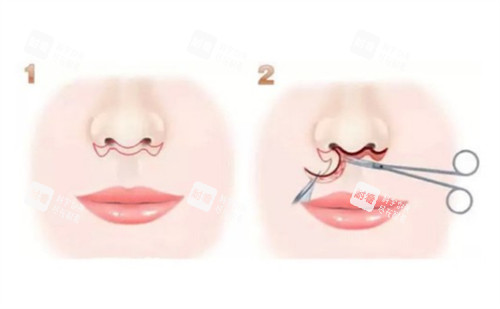 人中缩短术手术过程图解 人中缩短术手术过程图解