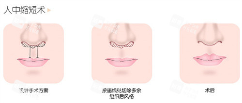人中缩短术 人中缩短术