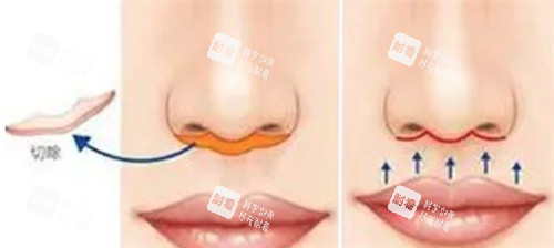 人中缩短手术 人中缩短手术