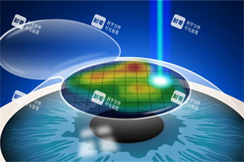 近视手术漫画示意图 近视手术漫画示意图