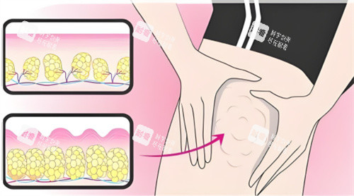 吸脂大腿部位 吸脂大腿部位