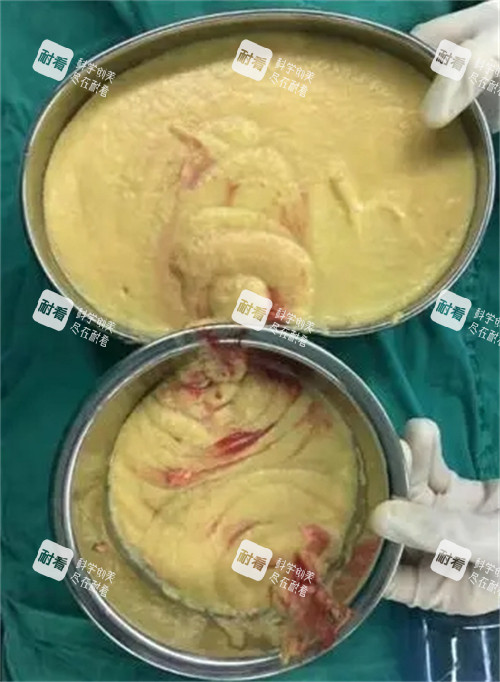 胸部不明注射物取出 胸部不明注射物取出