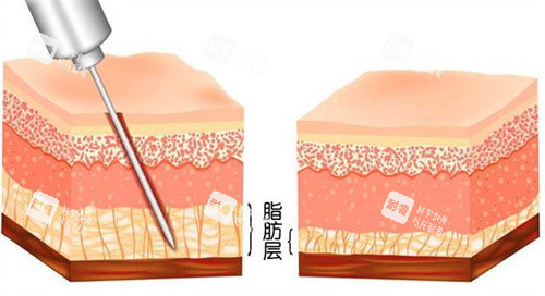 吸脂手术怎么做的