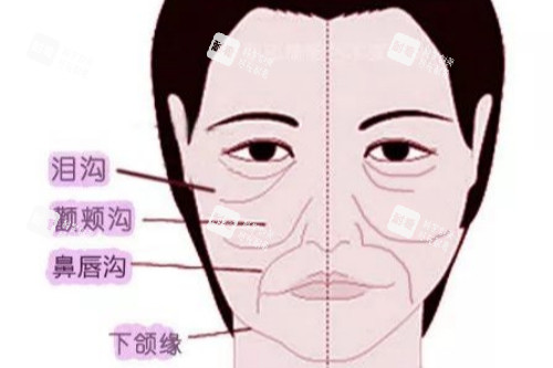 面部皱纹卡通图 面部皱纹卡通图