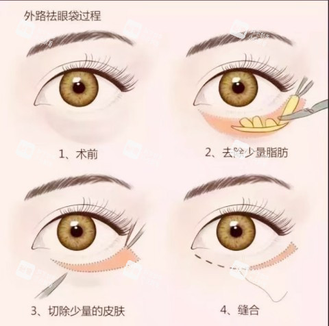 外路祛眼袋
