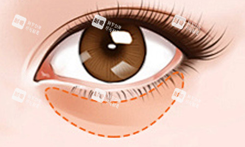 眼袋位置及颜色展示