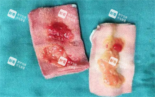太阳穴取出的生长因子