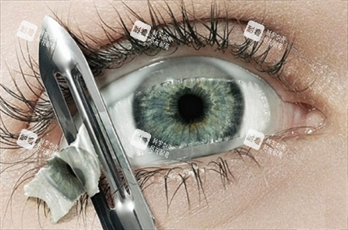 眼角膜割除眼睛局部图