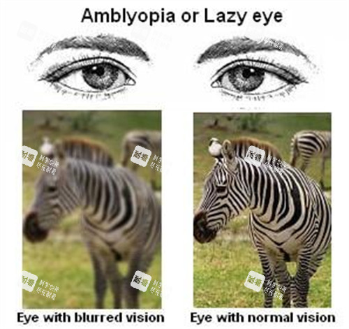 正常眼睛和弱视视野不一样