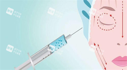 注射玻尿酸示意图